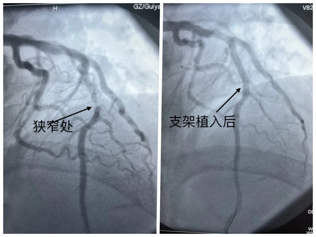 别不当回事！男子牙疼数日，没想到是心肌梗死……